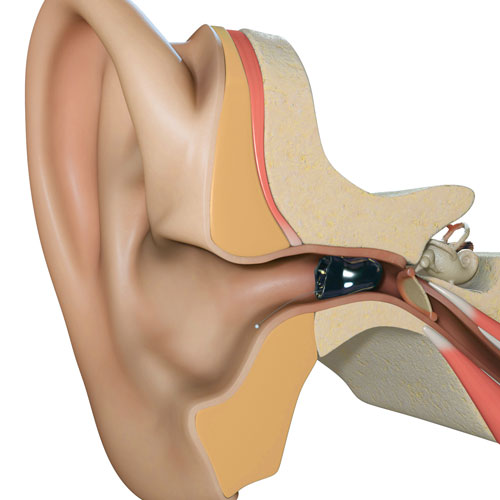invisible-in-the-canal-shown-in-ear